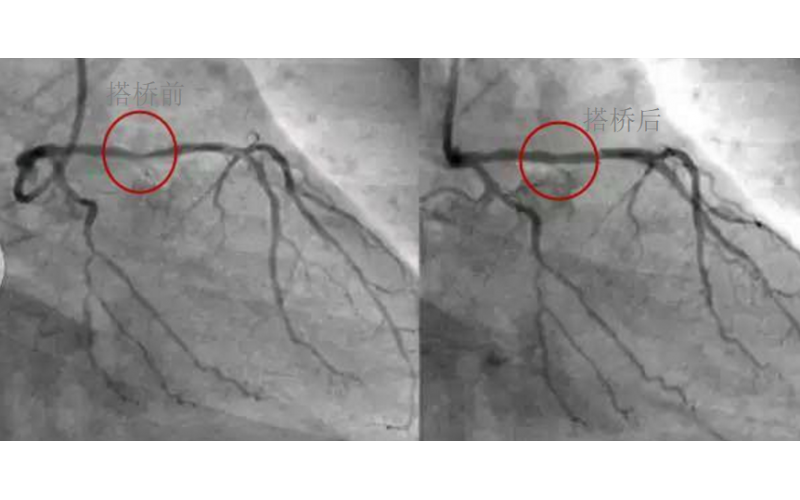深圳市模具廠對心臟支架的關(guān)注，國產(chǎn)化的道路有多長？